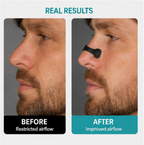 Nasal Dilator Kit